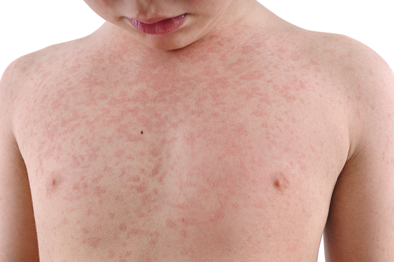 How Do You Get Rid of an Allergic Reaction Rash? - Oak Brook