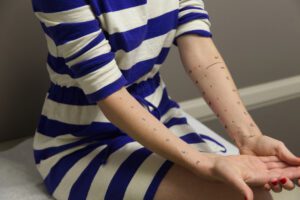 A Girls During Allergy testing