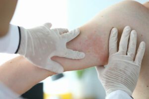 Close-up examination by doctor allergic rash. Doctor examines patient skin. Hands in medical gloves palpating skin with red rash. Examination by dermatologist, problem with health an allergy.