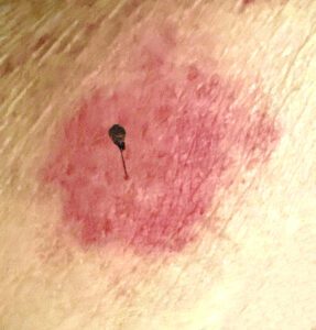 Bee sting on caucasian senior arm