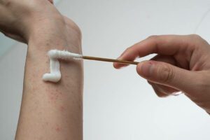 cotton swab with ointment spread on a wrist with eczema