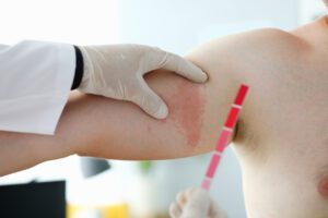 Allergist checking Irritated red skin