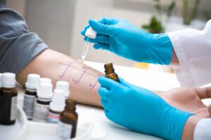 Skin prick allergy test to know the allergic reaction